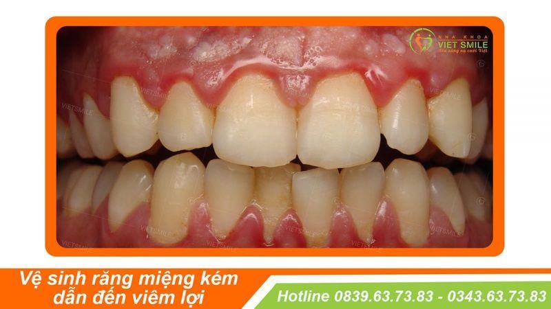Cao răng tích tụ quá nhiều gây viêm lợi