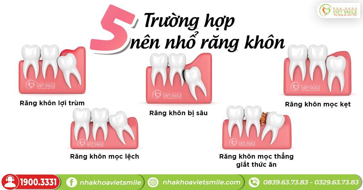 Các trường hợp thường được chỉ định nhổ răng khôn