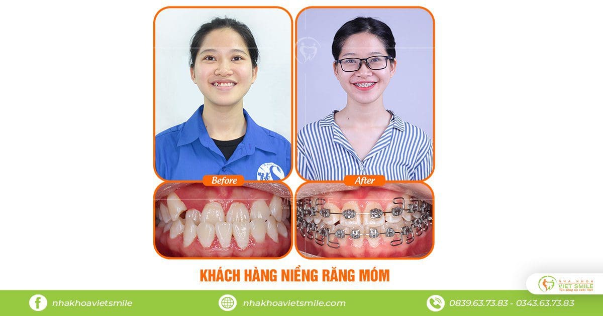 Niềng răng móm thay đổi mỗi ngày