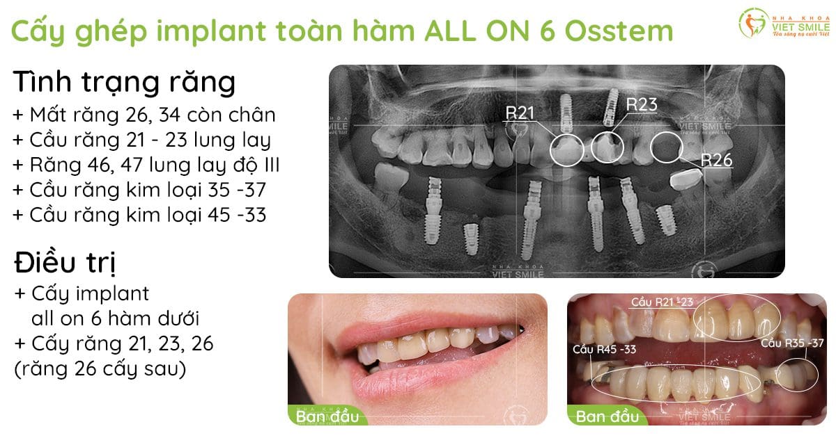 Cấy implant all on 6