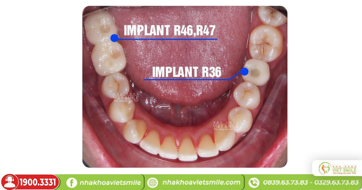Trồng implant 3 răng cho khách hàng