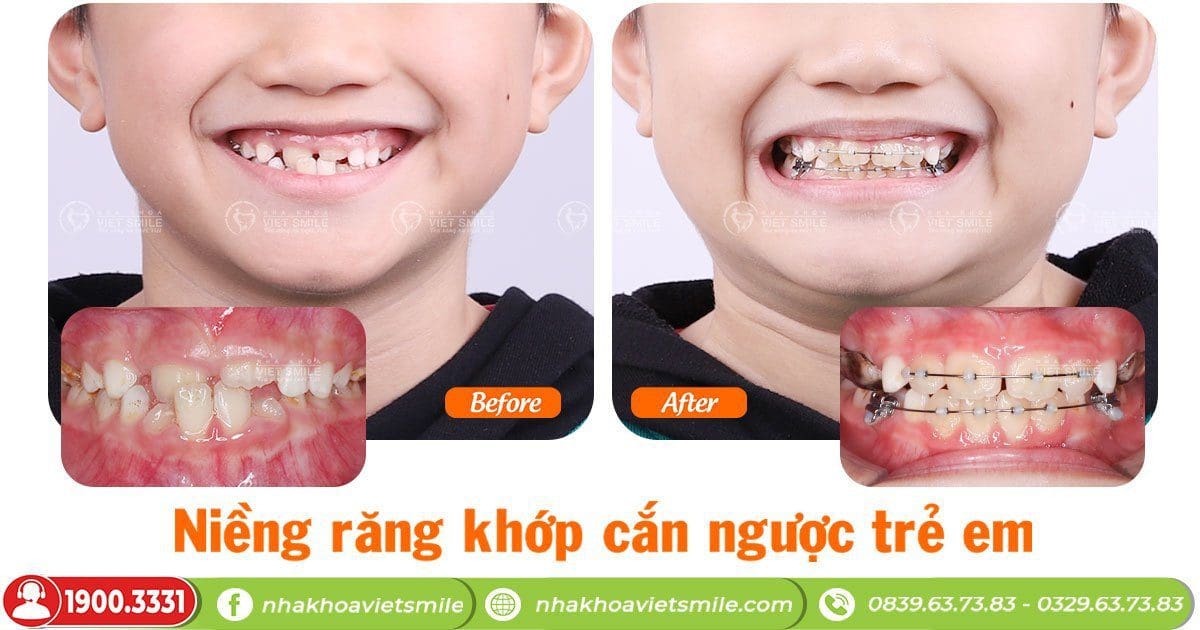 Niềng răng trọn gói cho trẻ - không nhổ răng