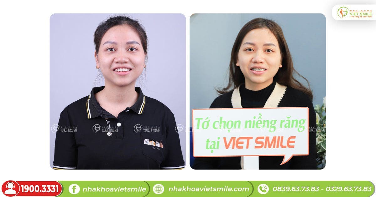 Niềng răng hô, khớp cắn hở sau 4 tháng- kh n. T thùy hn7220 2 Niềng răng khắc phục khớp cắn hở