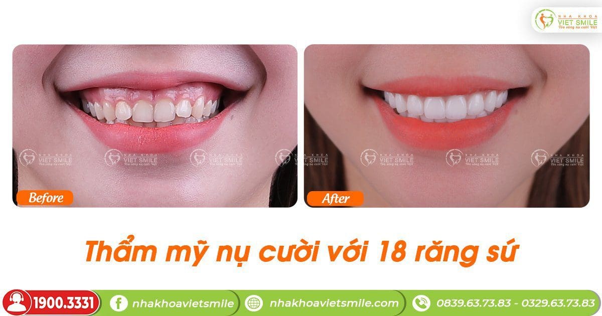 Trước và sau khi bọc răng sứ nacera đa lớp thủ công