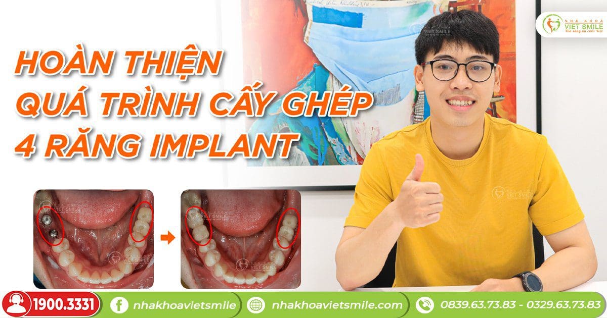 Hoàn thiện quá trình cấy ghép 4 răng implant