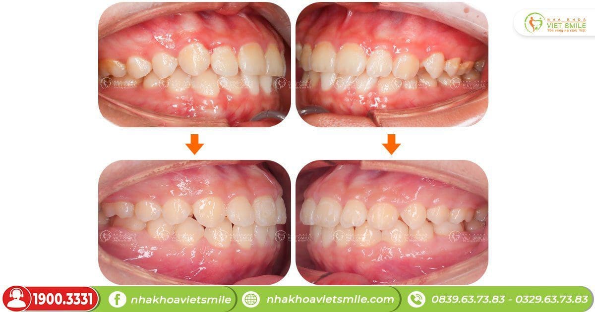 Trước và sau khi niềng răng tại việt smile