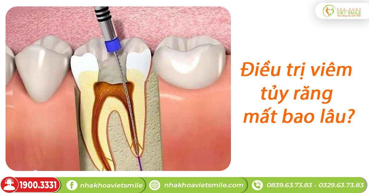 Điều trị viêm tủy răng mất bao lâu?