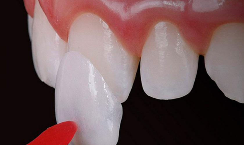 Khi nào bọc răng sứ, khi nào dán răng sứ, khi nào chỉnh nha?