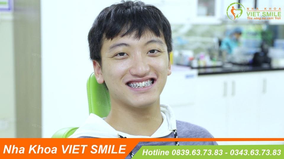 Niềng răng 1 hàm giá bao nhiêu? 11 niềng răng 1 hàm giá bao nhiêu tiền?