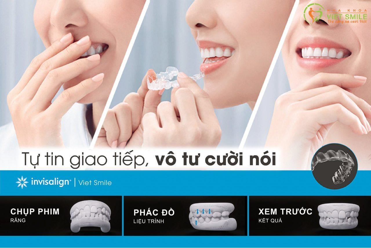 Niềng răng invisalign là gì? Vì sao niềng răng invisalign đắt nhưng vẫn được hàng triệu người săn đón 1 Niềng răng invisalign là gì? Vì sao niềng răng invisalign đắt