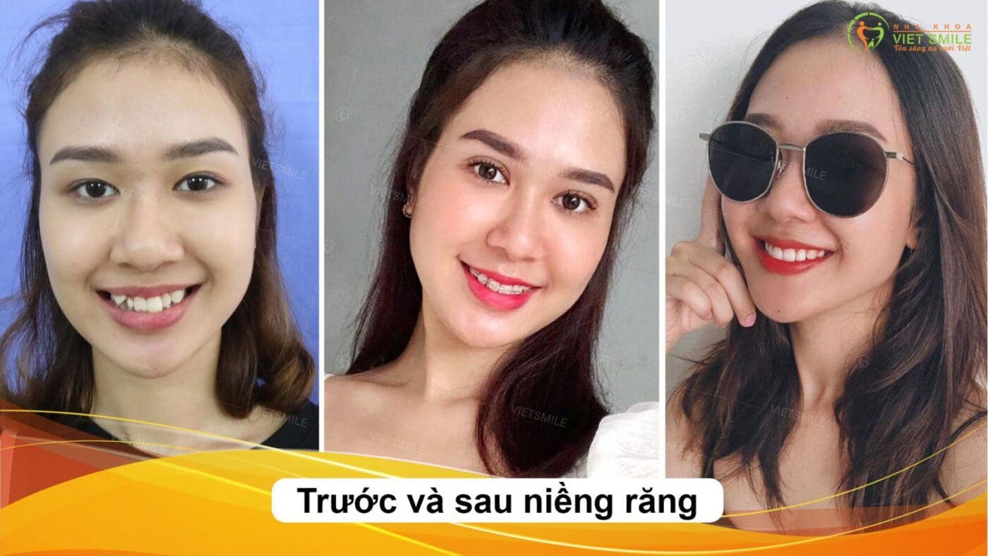 Review niềng răng đẹp mỗi ngày - loạt ảnh tiếp thêm động lực cho bạn 3 Trước sau niềng răng