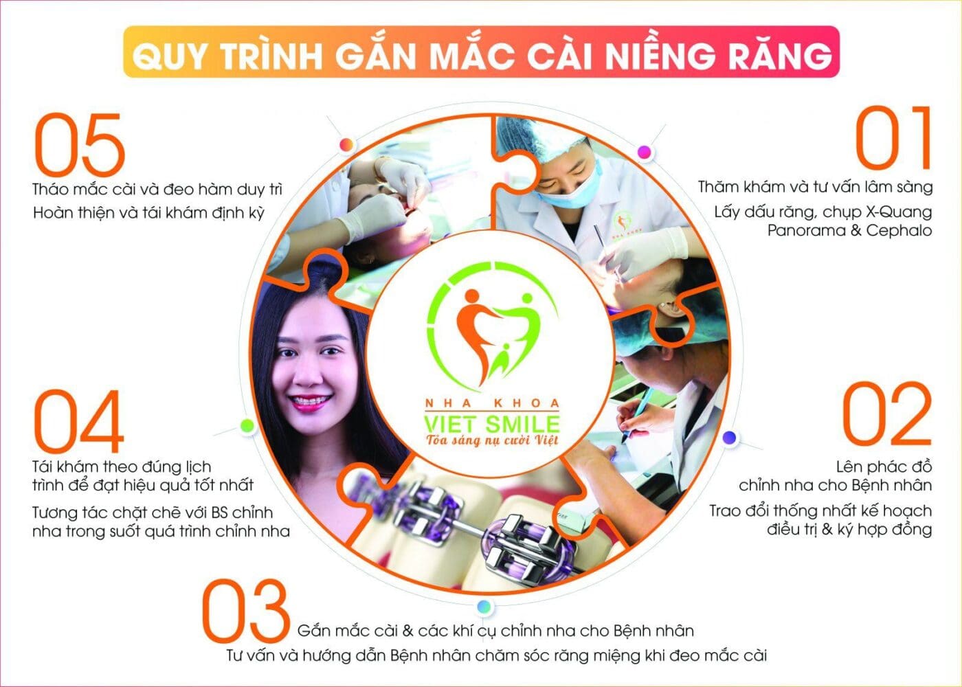 Quy trình niềng răng khểnh tại Việt Smile