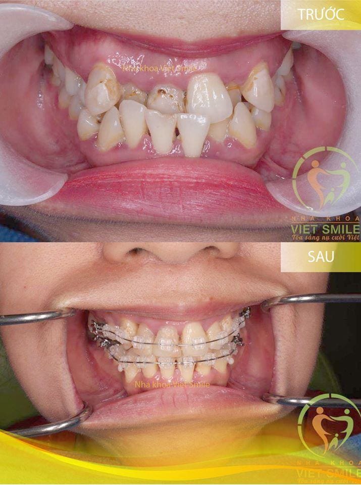 Niềng cải thiện móm răng là 1 biện pháp an toàn và cho hiệu quả cao nếu bạn được bác sĩ chuyên môn giỏi