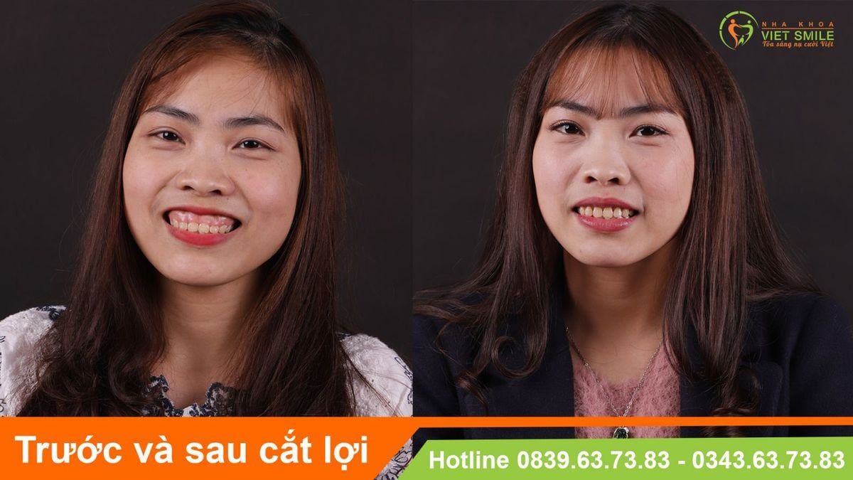 Bạn đã biết 5 nguyên nhân gây cười hở lợi? 3 Vietsmile 5 nguyen nhan khien ho loi 1