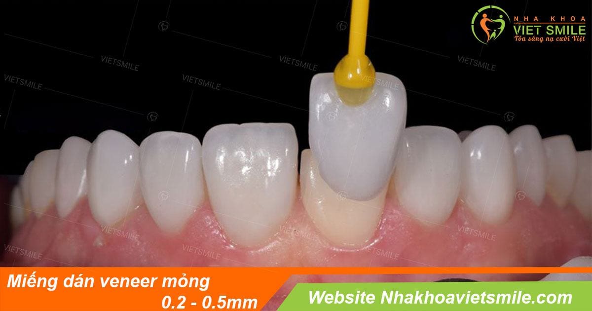 Vietsmile dan su veneer khong mai