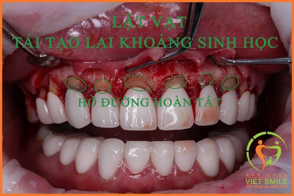 Bọc răng sứ đúng kĩ thuật: khắc phục hậu quả của bọc răng sứ sai kỹ thuật 3 Hau qua lam rang su sai