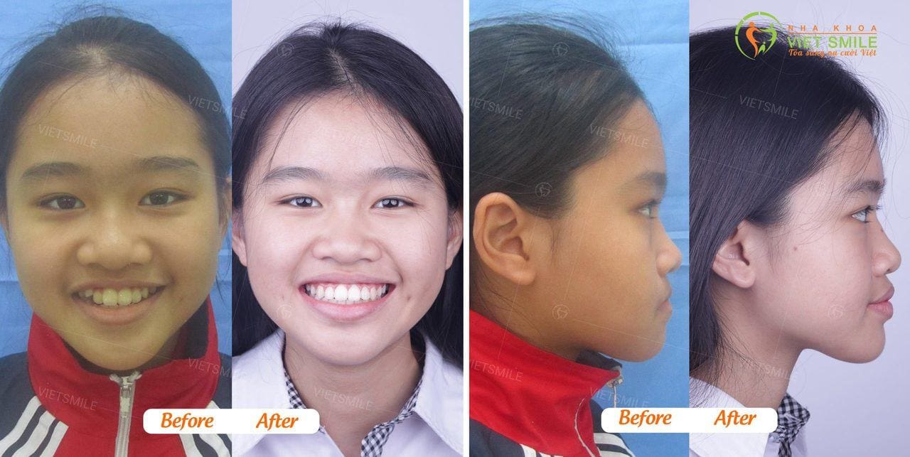 Niềng răng mất bao lâu? Khi nào nhận thấy sự thay đổi? 4 Vietsmile nieng rang mat bao lau 1