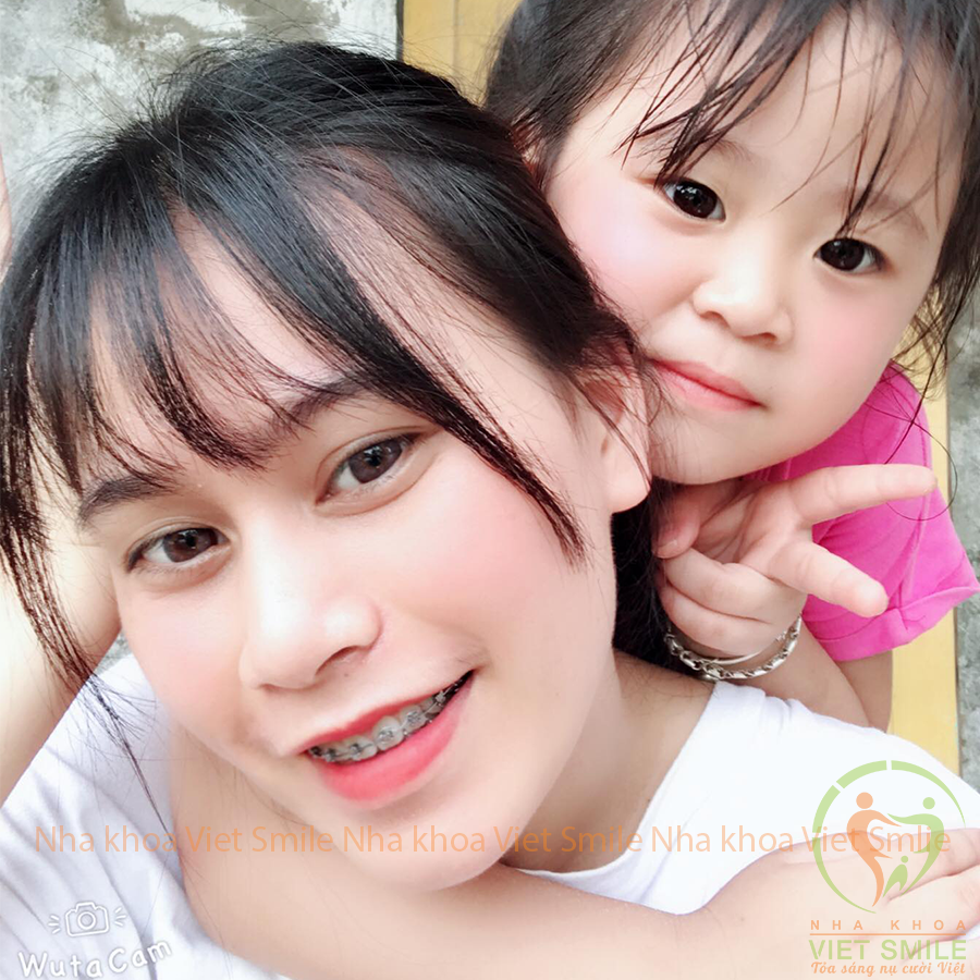 niềng răng mất bao lâu? khi nào nhận thấy sự thay đổi? 3 Vietsmile nieng rang mat bao lau.
