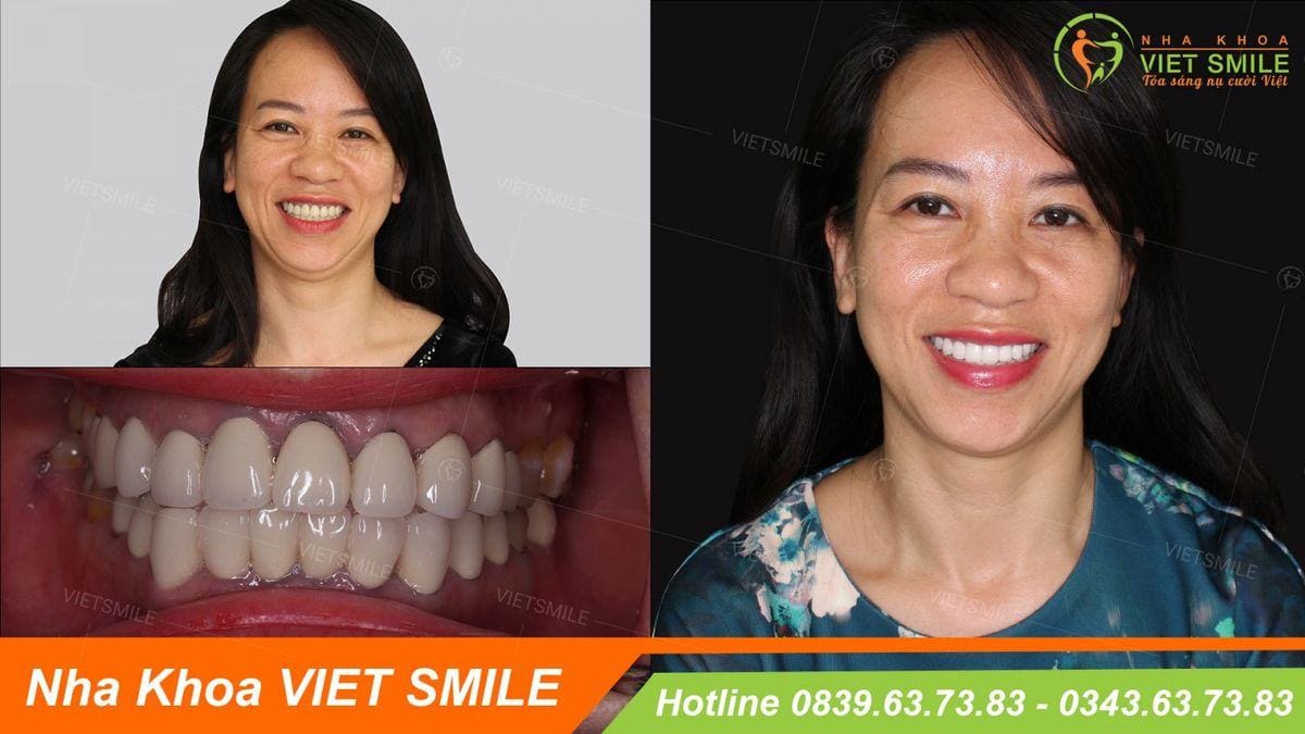 tại nha khoa uy tín số 1 miền bắc bọc răng sứ hết bao nhiêu tiền? 3 Rang su kim loai