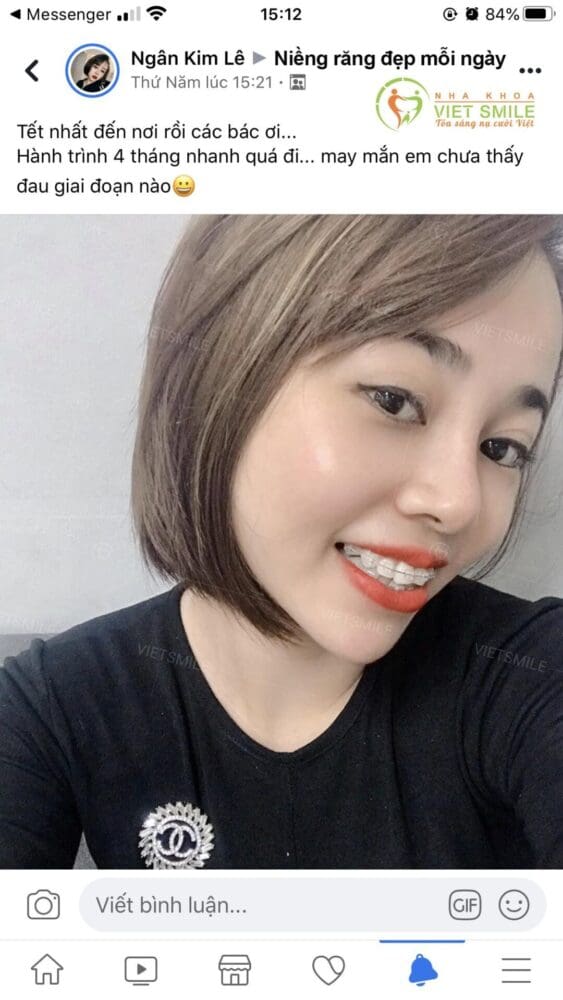 bọc răng sứ là gì? có nên bọc răng sứ cho răng hô, sai khớp cắn? 4 Vietsmile boc rang su cho rang khap khenh nhieu duoc khong