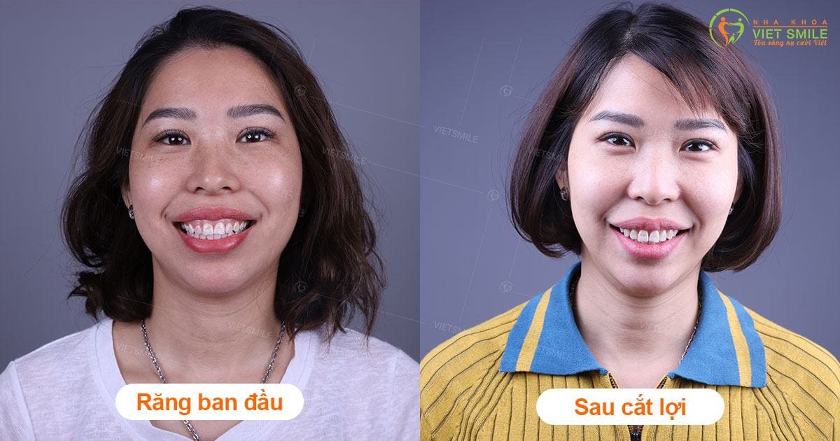 dán sứ veneer răng kết hợp điều trị cười hở lợi 3 Vietsmile dieu tri cuoi ho loi o dau an toan 2