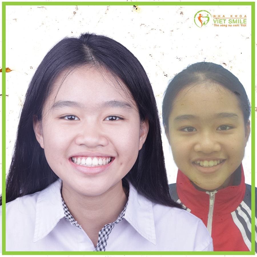 niềng răng mắc cài kim loại và những điều không thể bỏ qua 5 Vietsmile ket qua nieng rang mac cai kim loai