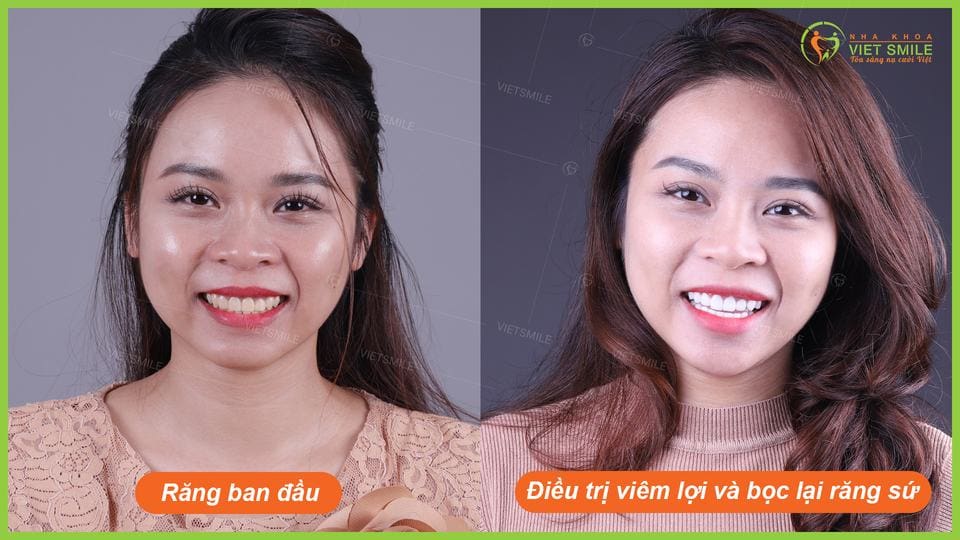 quy trình bọc răng sứ chuẩn quốc tế tại nha khoa việt smile 5 Vietsmile quy trinh boc su