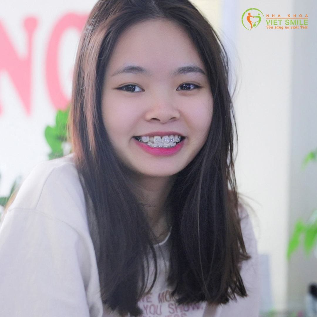 răng khểnh là gì? răng khểnh cười duyên và ý nghĩa của răng khểnh 5 Vietsmile trang trang