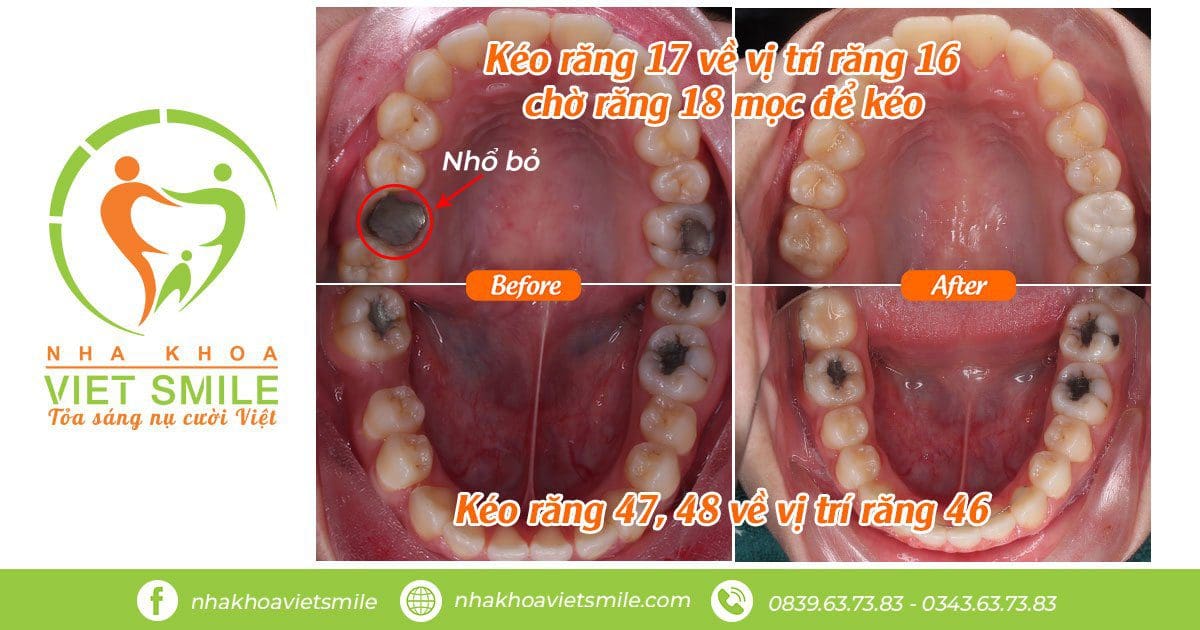 niềng răng 10 Thay thế răng mất