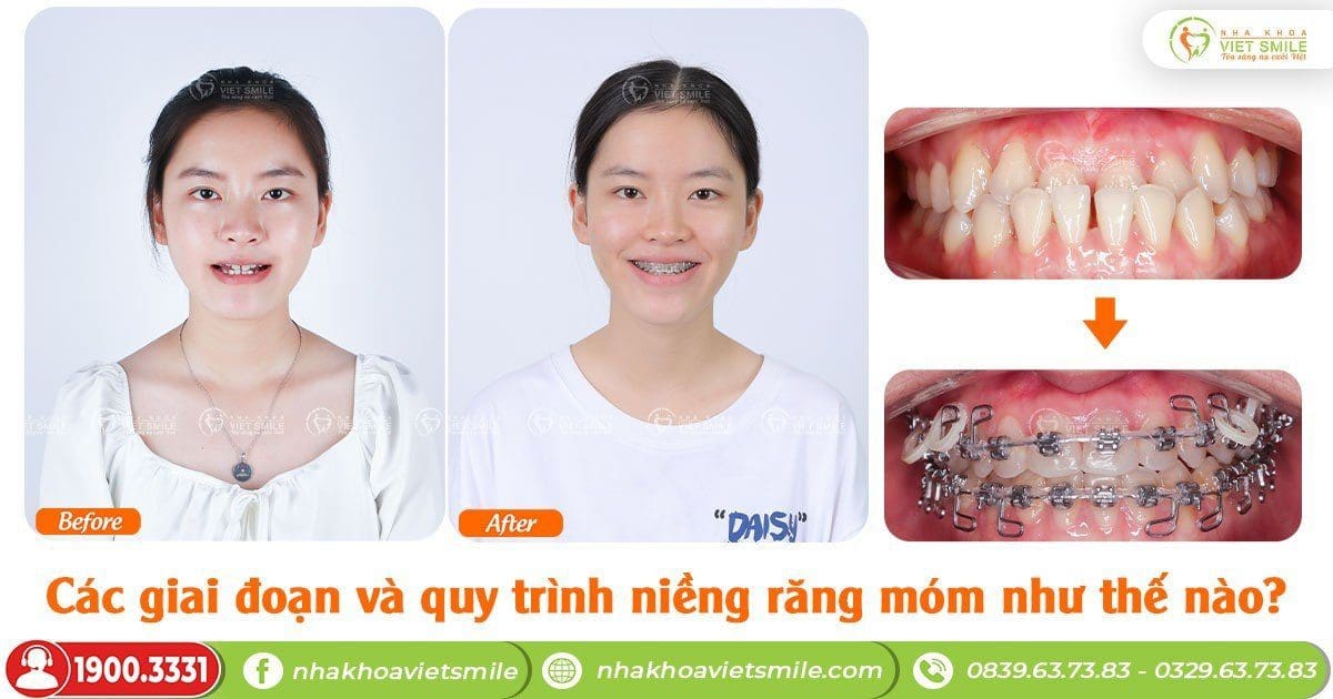 Các giai đoạn và quy trình niềng răng móm như thế nào?