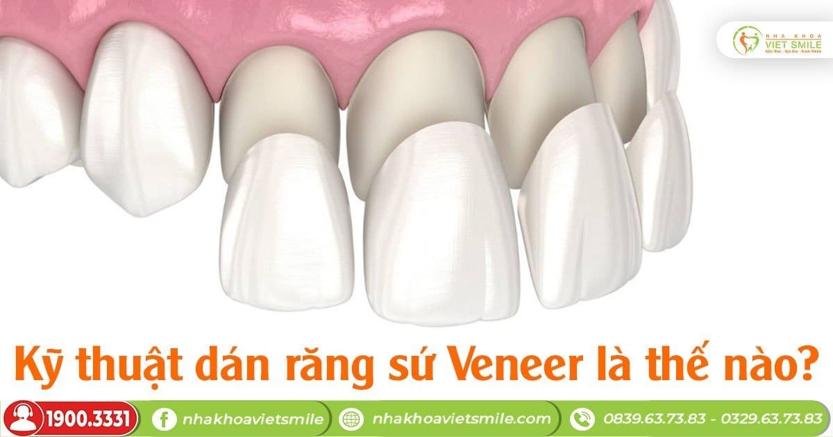 Kỹ thuật dán răng sứ Veneer là thế nào?