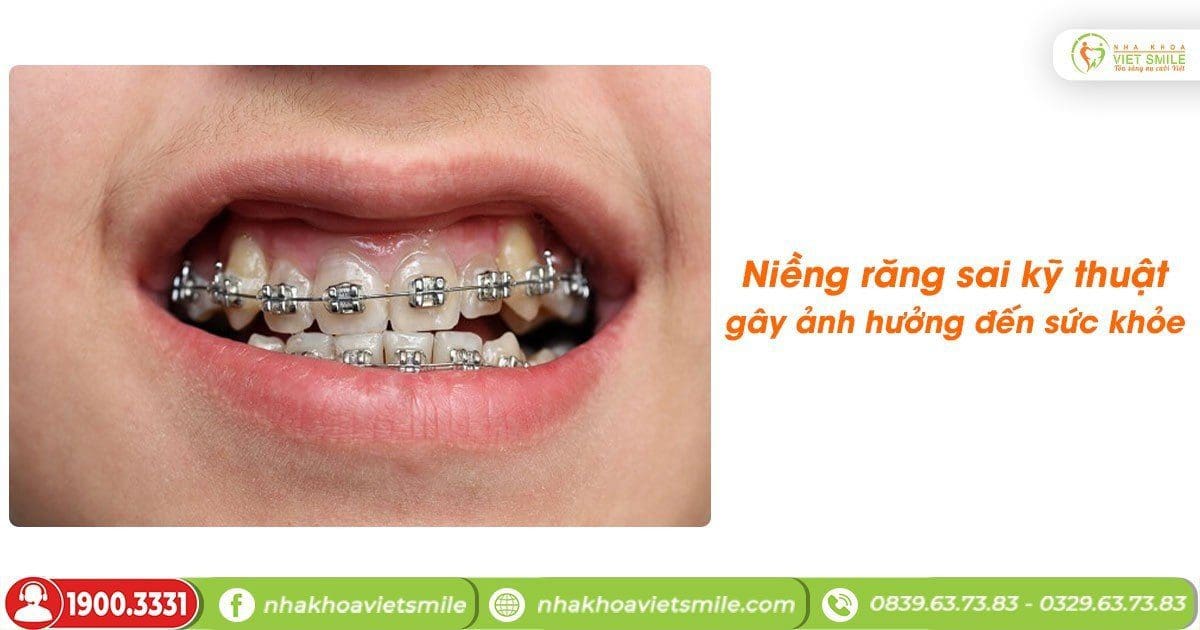 Niềng răng sai kỹ thuật gây ảnh hưởng đến sức khỏe