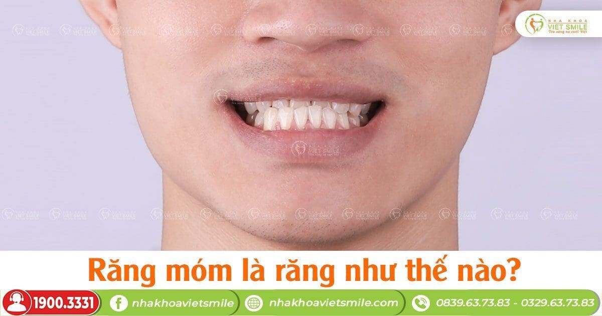 Răng móm là răng như thế nào?