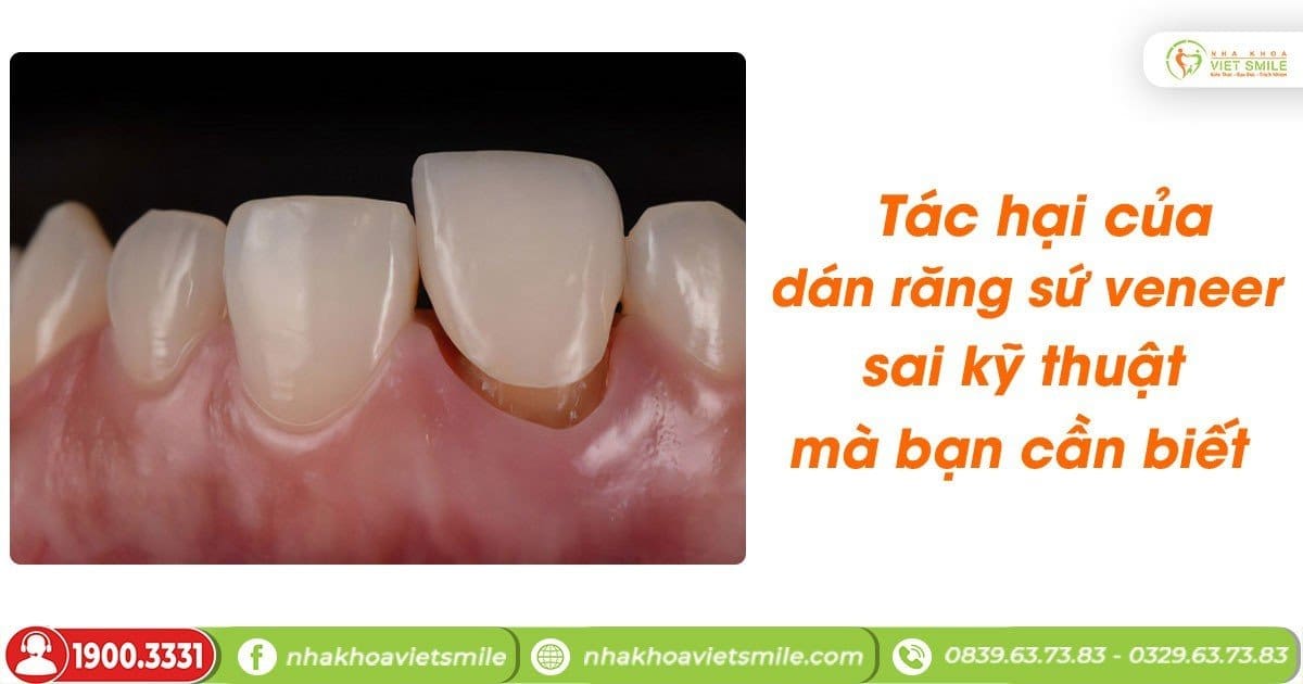 Tác hại của dán răng sứ veneer sai kỹ thuật mà bạn cần biết