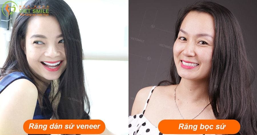 dán sứ veneer có bong không? bao lâu phải làm lại? 4 Boc rang su