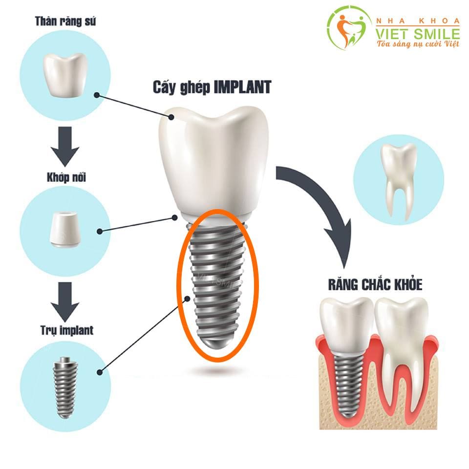 Cấu tạo của răng implant