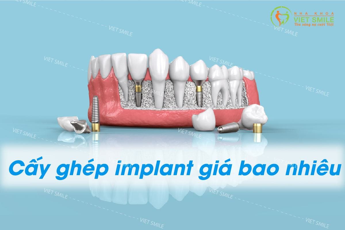 bảng giá trồng răng implant mới nhất 1 Bảng giá trồng răng implant
