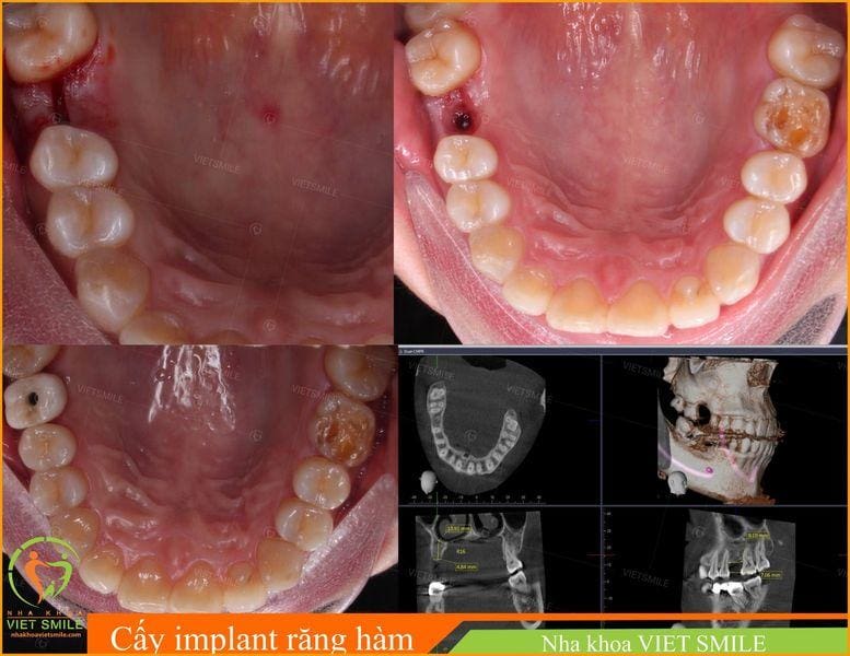 trồng răng giả là gì? tổng hợp kiến thức liên quan 3 Vietsmile tong hop kien thuc lien quan ve trong rang gia
