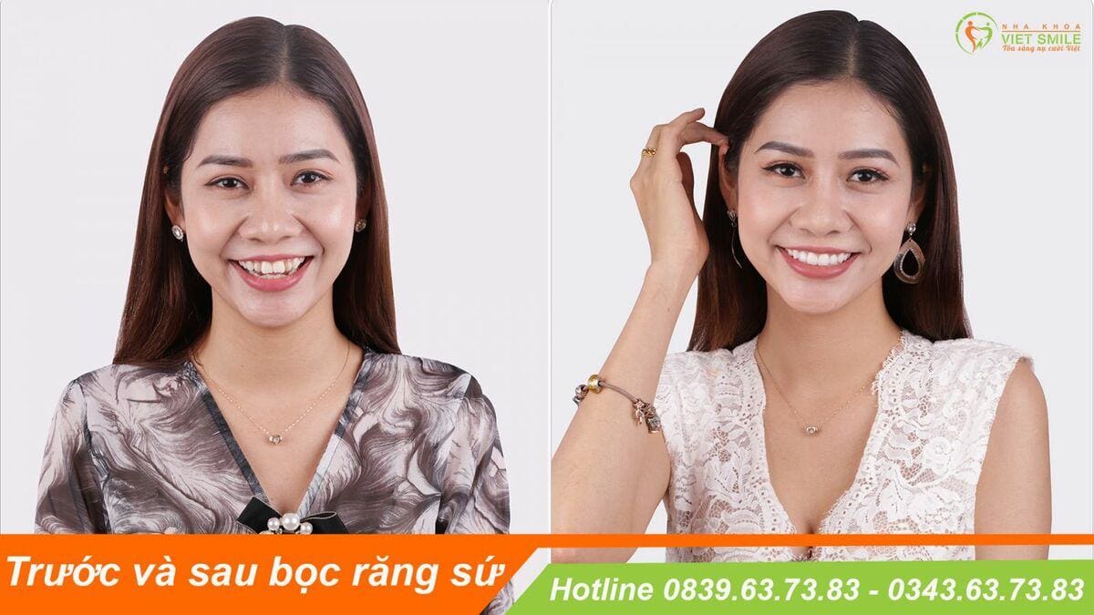 review bọc răng sứ? bọc răng sứ có hại không? 1 Review boc rang su