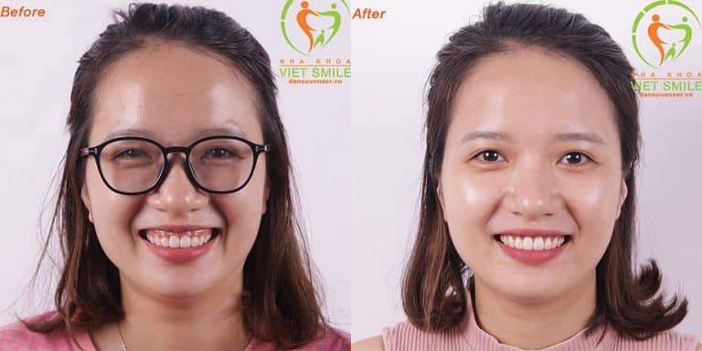 cắt lợi thẩm mỹ có bị tái phát không? chia sẻ từ khách hàng 1 Vietsmile cat loi tham my co bi tai phat khong