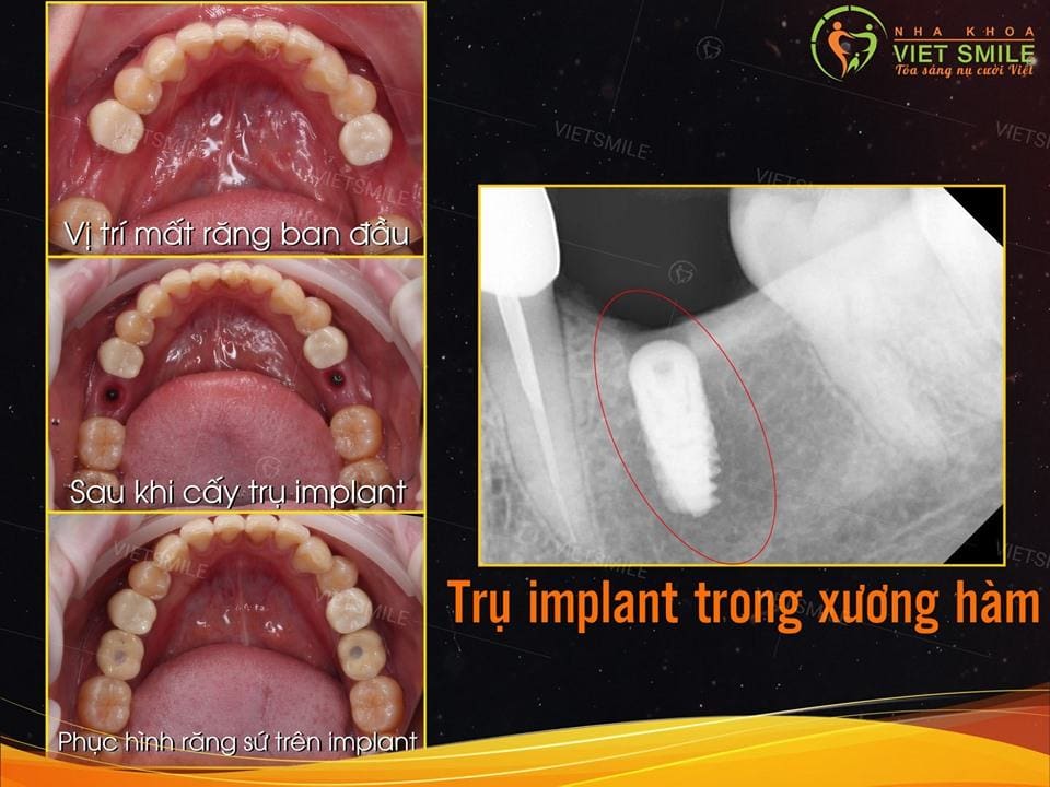 Implant là gì? Ưu điểm của cấy ghép răng implant? 4 Cấy ghép răng implant