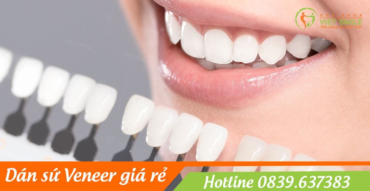 có nên dán sứ veneer không? hỏi đáp kinh nghiệm làm răng 1 Vietsmile co nen dan su veneer khong