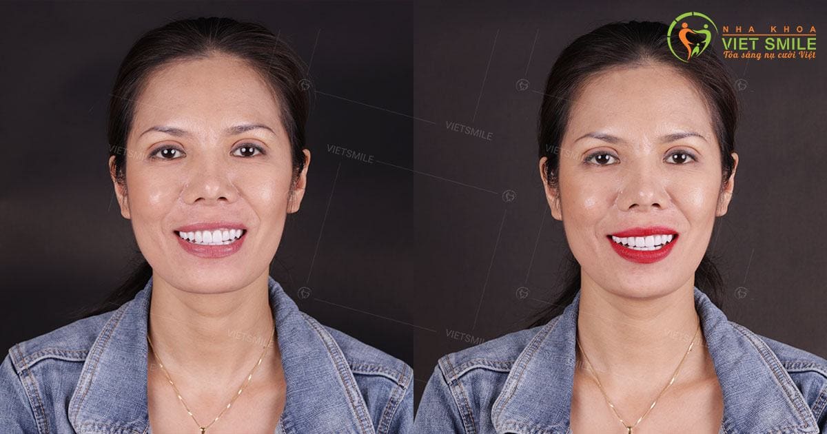 Khách hàng hải ngoại tin tưởng chọn dán sứ veneer emax tại việt smile 3 Vietsmile dan su veneer emax chinh hang