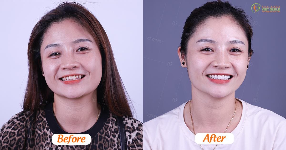 cần tìm hiểu những vấn đề gì trước khi dán sứ veneer 3 Vietsmile dan su veneer dep