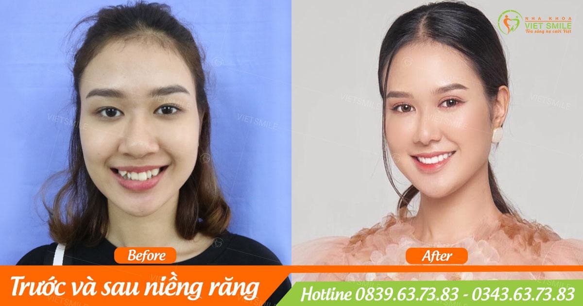 niềng răng 1 hàm giá bao nhiêu tiền? 5 Ket qua nieng rang