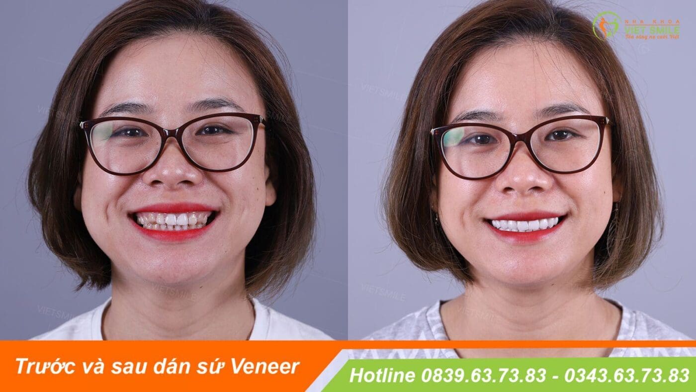 miếng dán veneer có thật sự tốt như quảng cáo? 1 Mieng dan su veneer tot khong