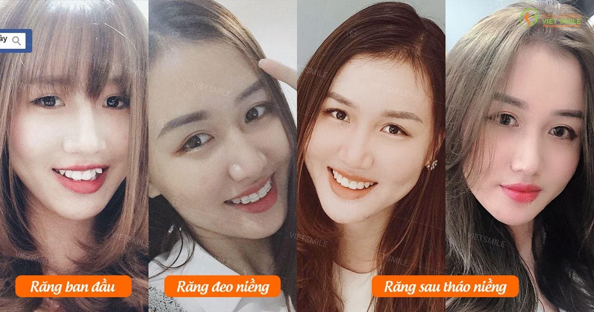 vì sao niềng răng mắc cài kim loại tự buộc được lựa chọn nhiều nhất? 3 Ket qua nieng rang mac cai
