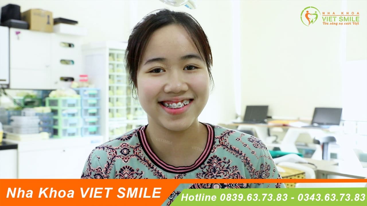răng khểnh 1 bên là gì, cười sao cho đẹp, có nên niềng răng khểnh không? 2 Vietsmile rang khenh 1 ben la gi