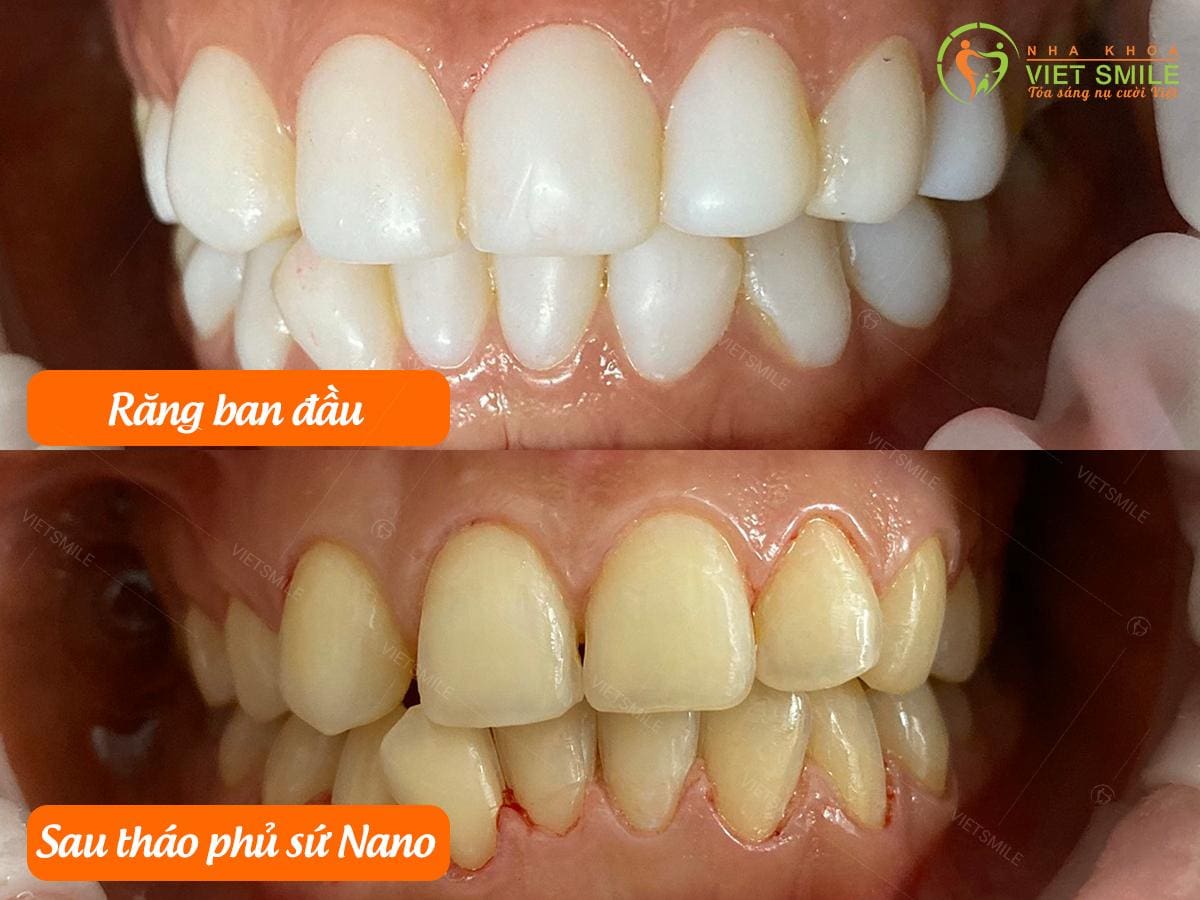 Địa chỉ nha khoa tháo phủ sứ nano uy tín 1 Phu su nano
