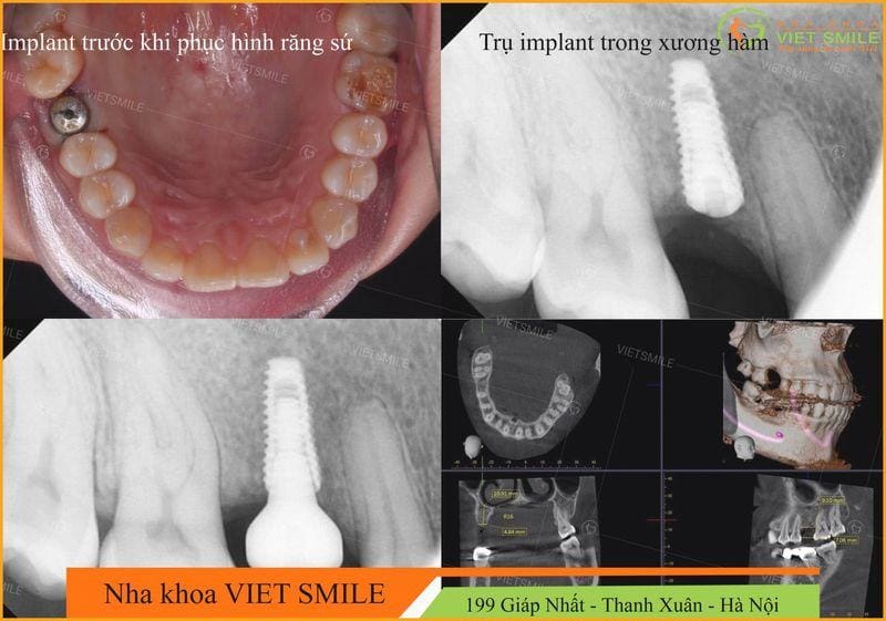 trồng răng implant ở đâu tốt nhất 5 Trong rang implant an toan